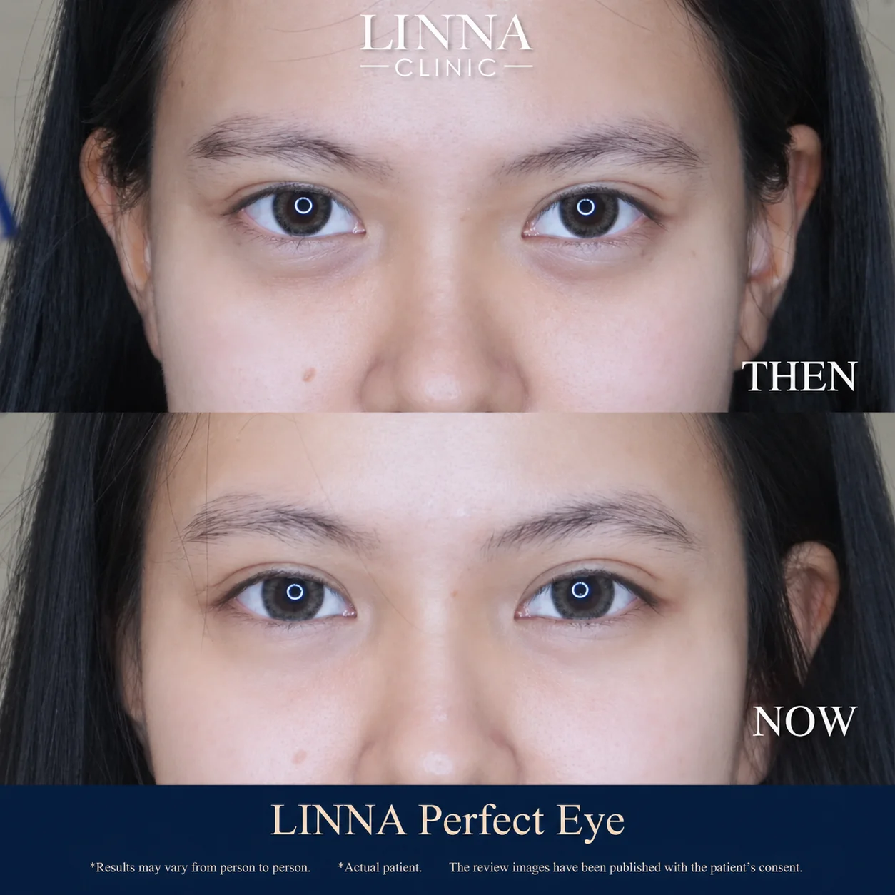 LINNA Perfect Eye before and after review 8