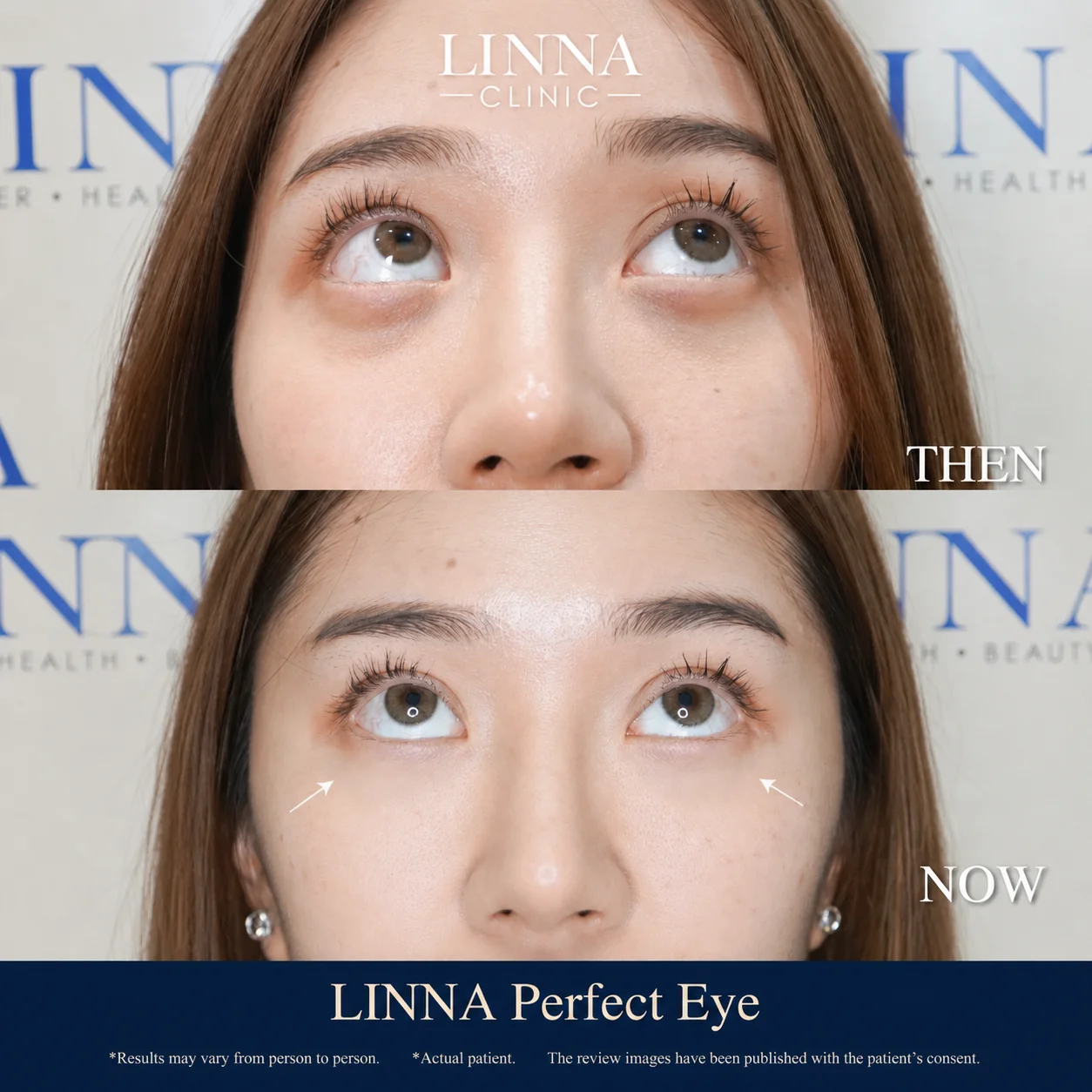 LINNA Perfect Eye before and after review 3