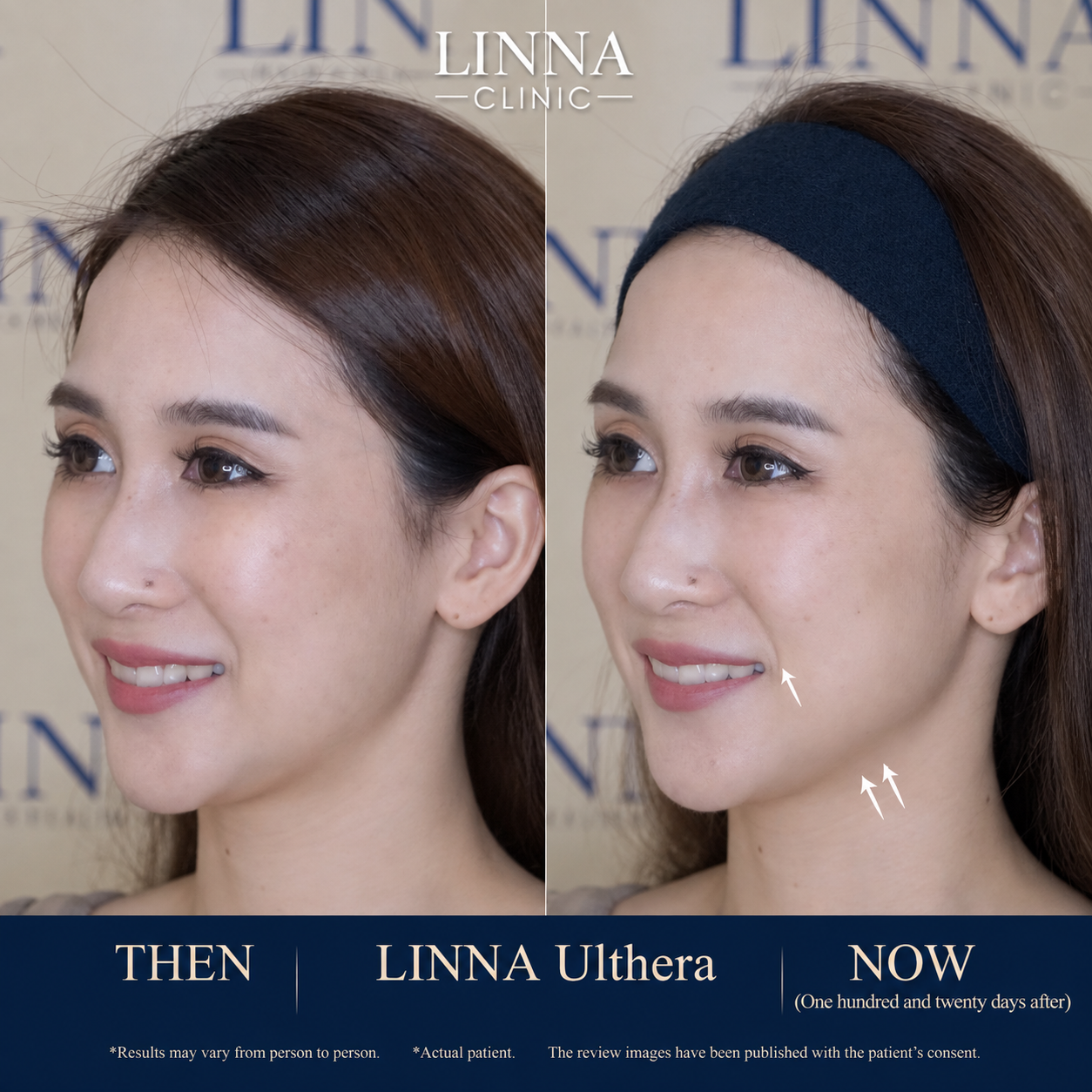 LINNA Ulthera SPT before and after result