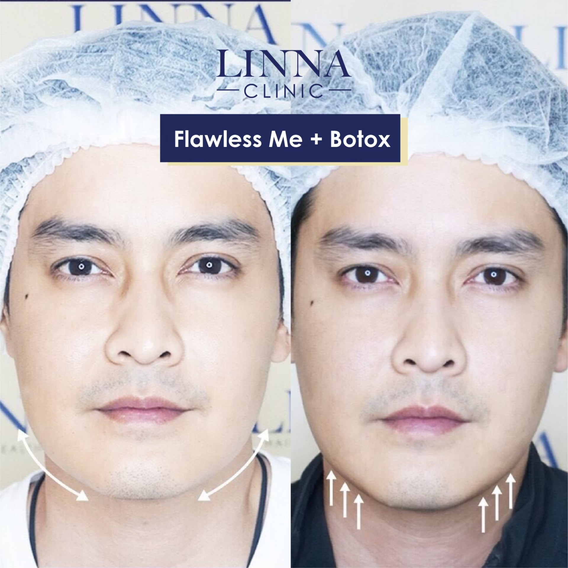 LINNA Clinic Bo ช่วยลดริ้วรอย ปรับรูปหน้าและรูปคิ้ว ไม่มีผลข้างเคียงและไม่ทิ้งสารตกค้างภายในร่างกาย