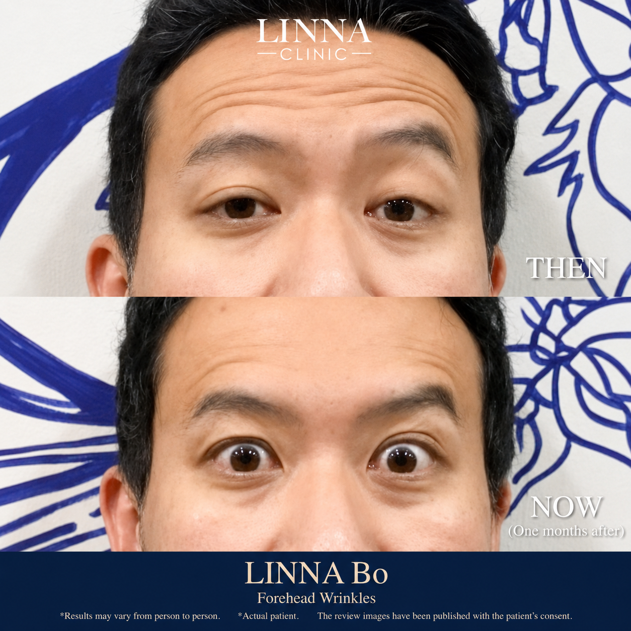 LINNA Clinic Bo ช่วยลดริ้วรอย ปรับรูปหน้าและรูปคิ้ว ไม่มีผลข้างเคียงและไม่ทิ้งสารตกค้างภายในร่างกายอ