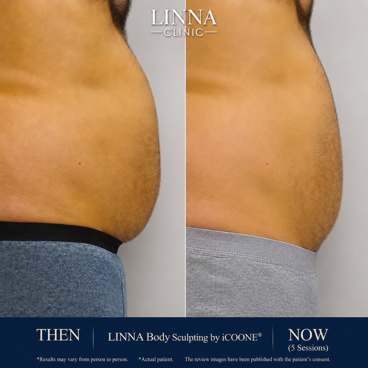 LINNA Body Sculpting by iCOONE® at LINNA Clinic