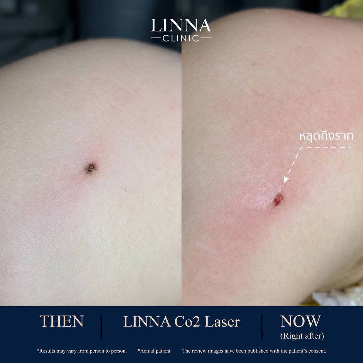 รีวิว Co2 Laser ก่อนและหลัง