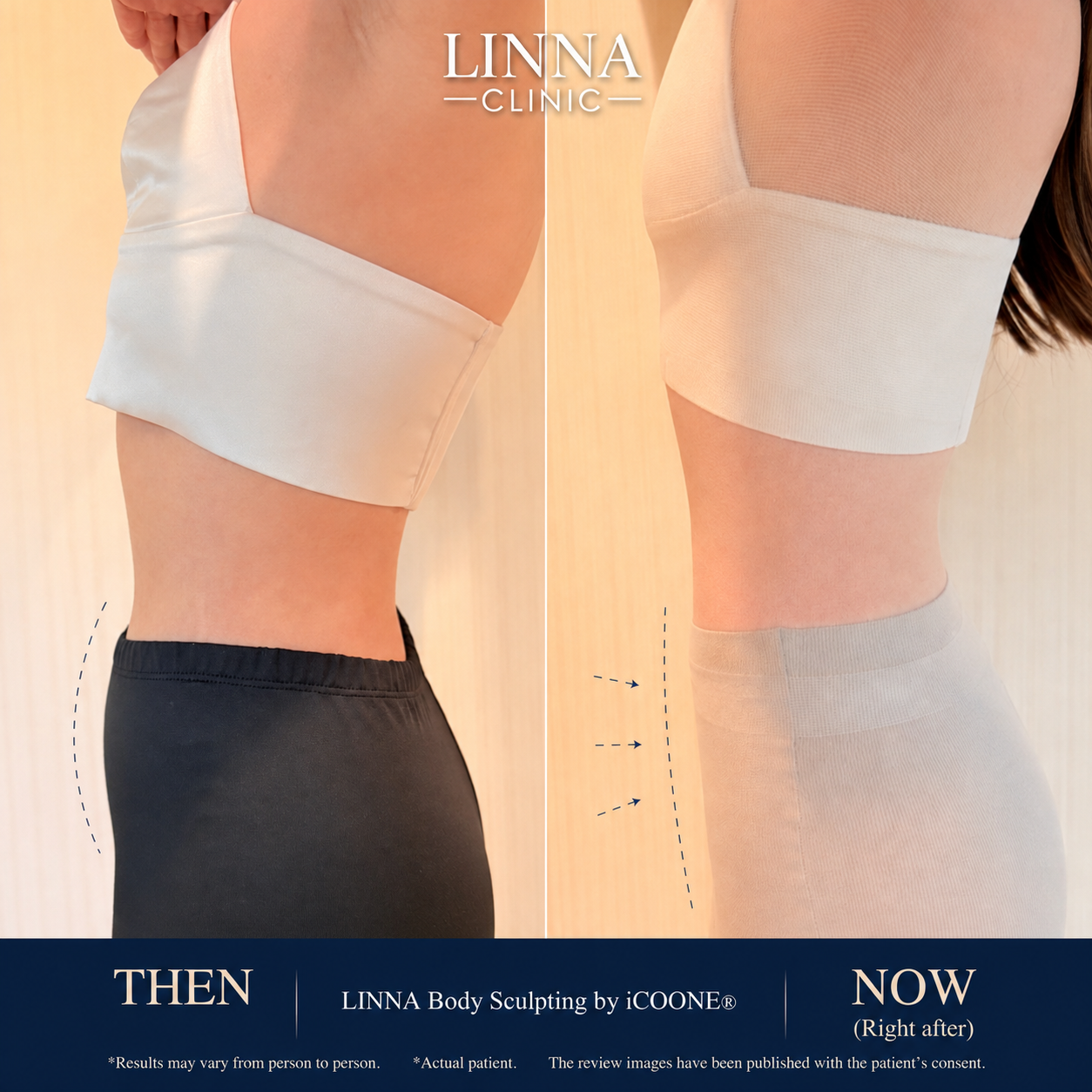 LINNA Body Sculpting by iCOONE®: Reduce Inches, Firm the Skin, and Improve the Appearance of Cellulite Without Downtime — Technology from Italy