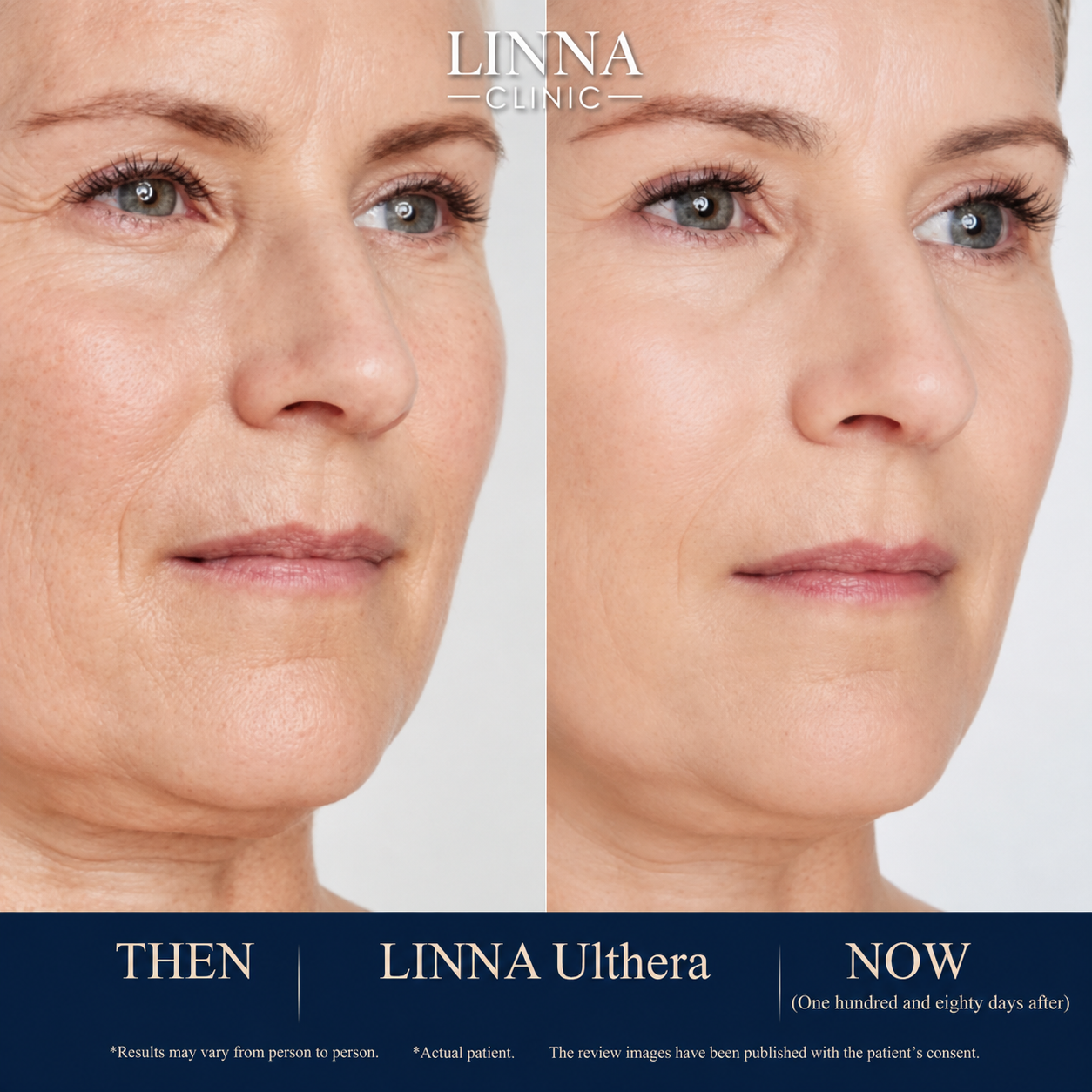 LINNA Ulthera SPT before and after result
