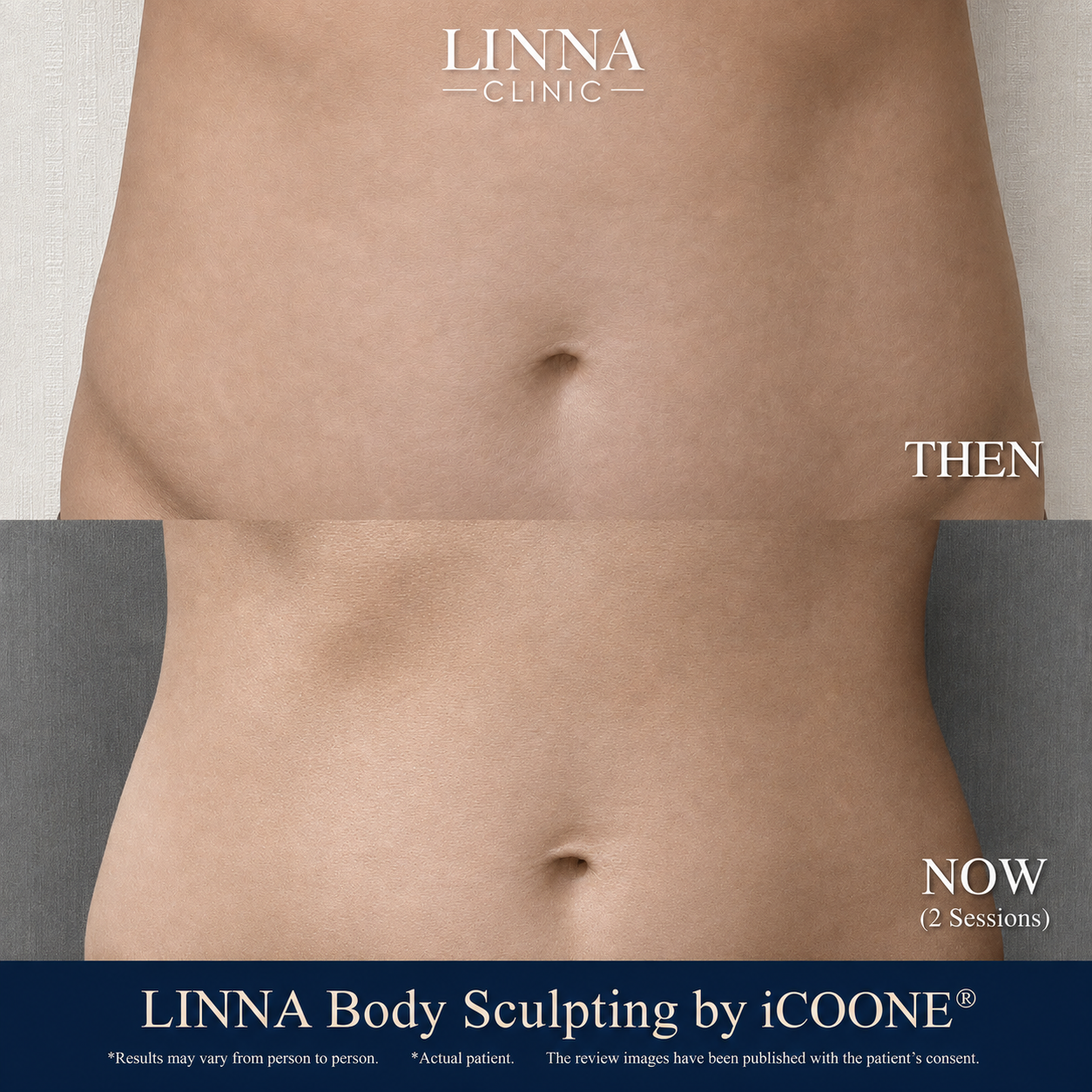 LINNA Body Sculpting by iCOONE® at LINNA Clinic