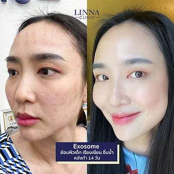 LINNA Clinic treatment result
