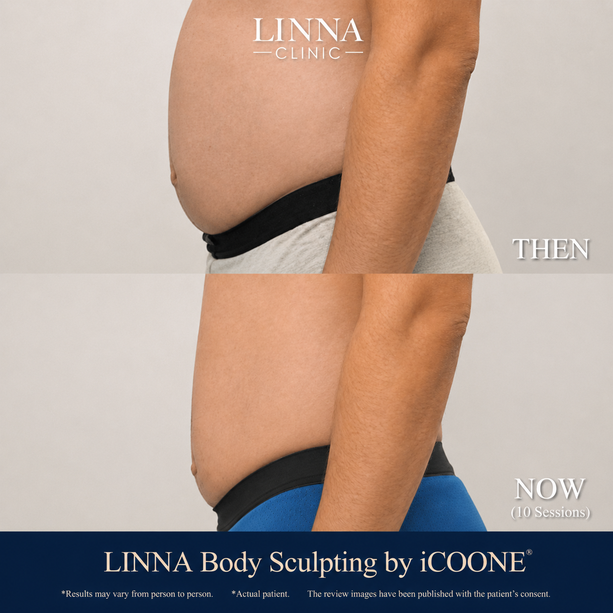 LINNA Body Sculpting by iCOONE® at LINNA Clinic