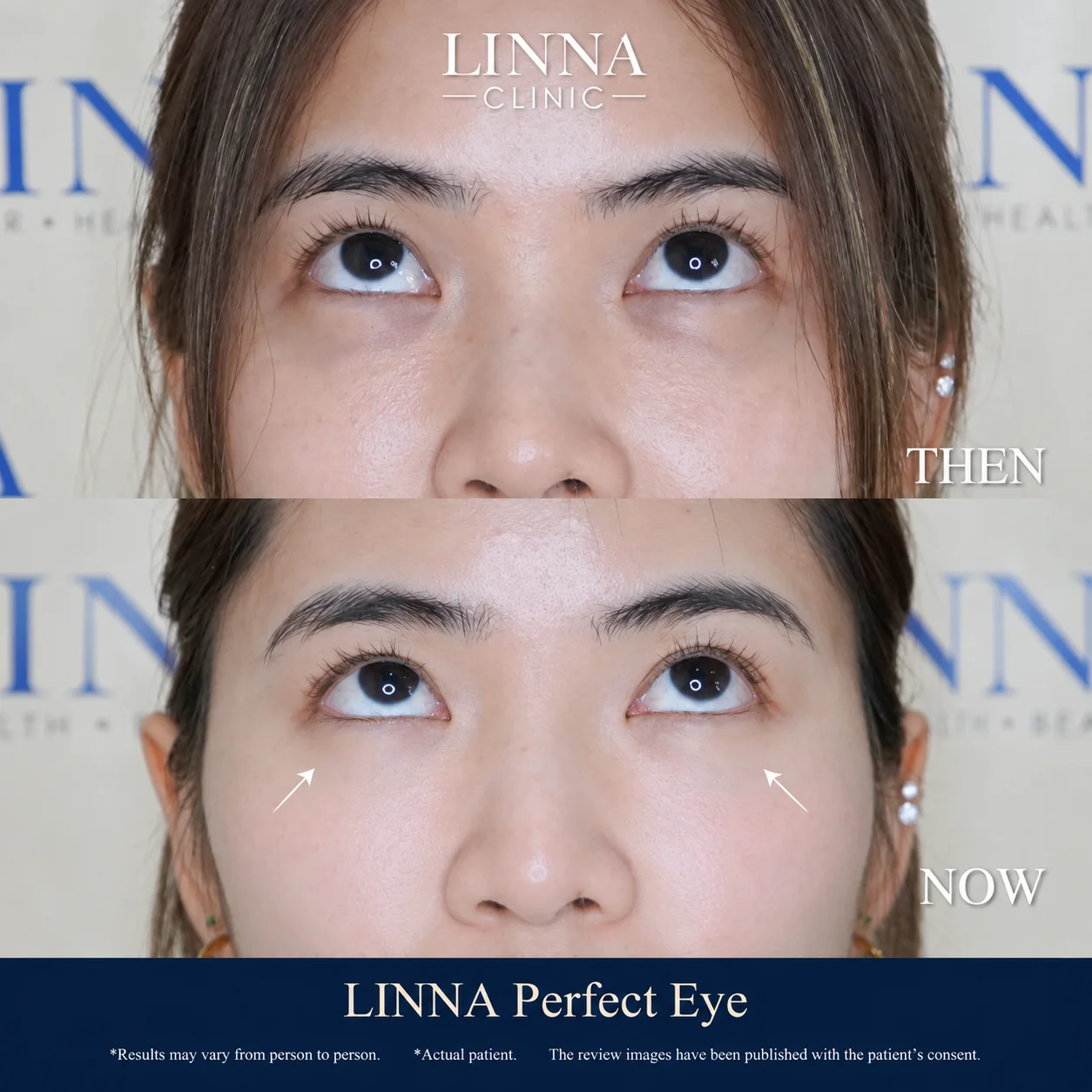 LINNA Perfect Eye before and after review 4