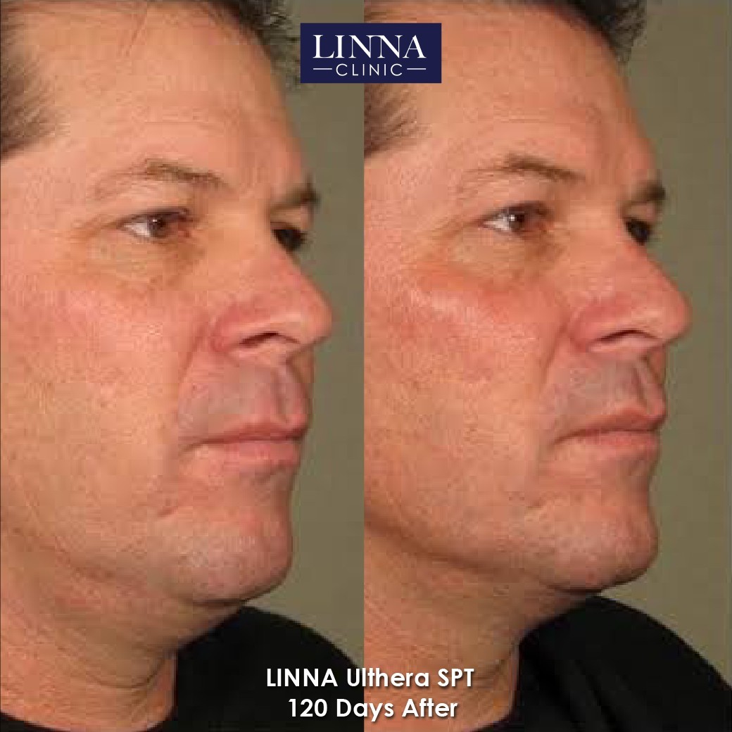 LINNA Ulthera SPT before and after result