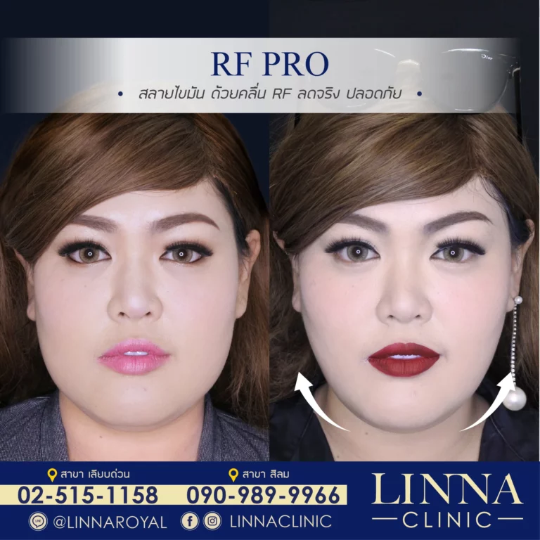 LINNA RF Pro at LINNA Clinic