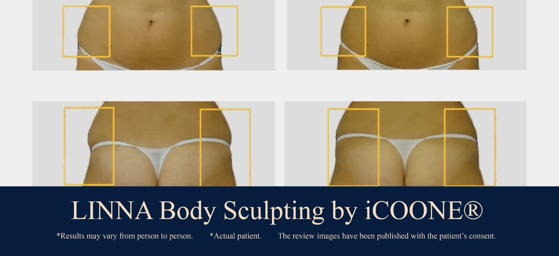 LINNA Body Sculpting by iCOONE® abdomen and hips before and after