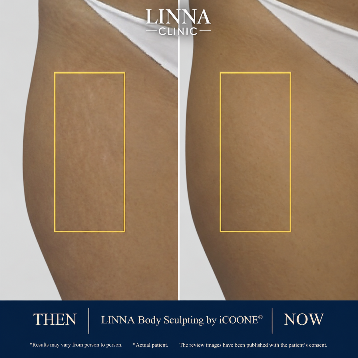 LINNA Body Sculpting by iCOONE® body contour before and after
