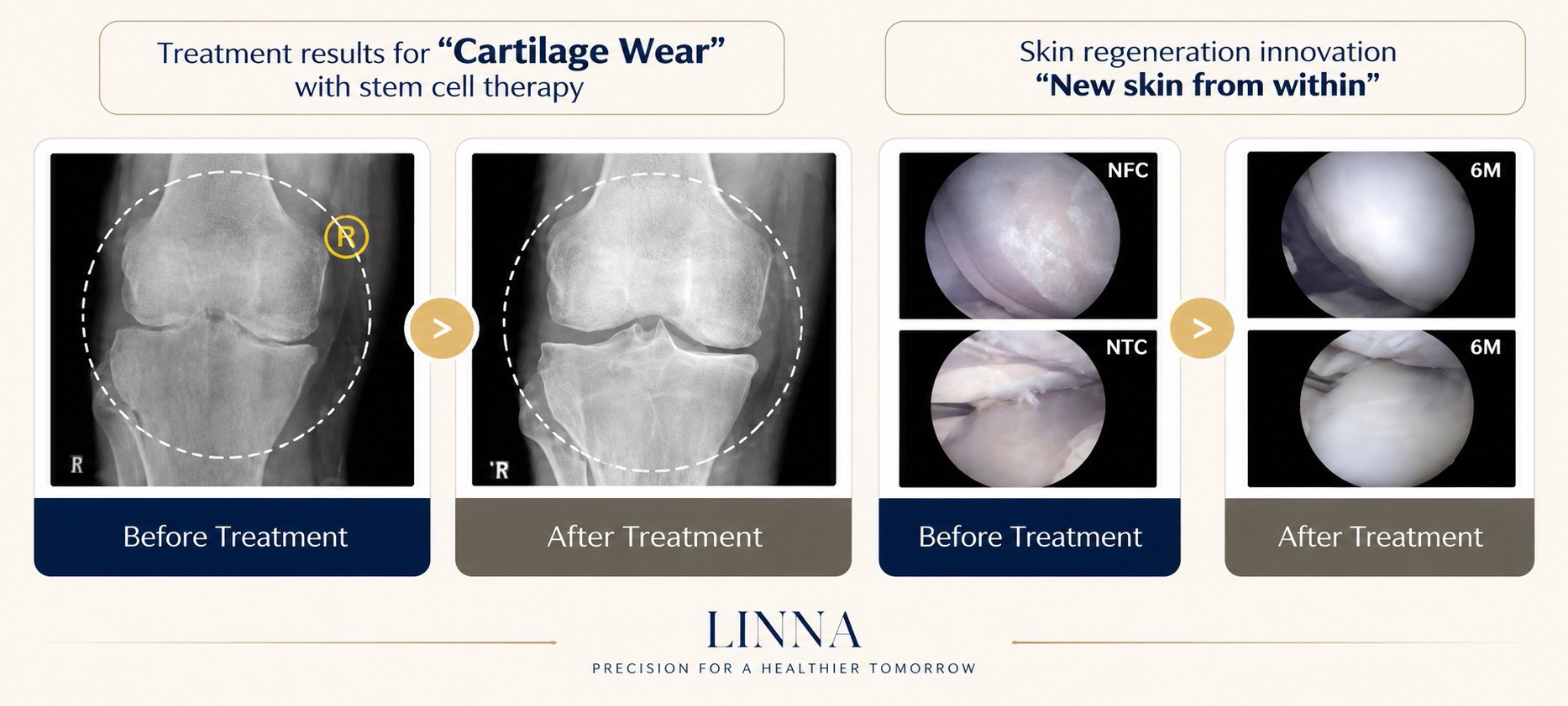 Before and after knee cartilage treatment results