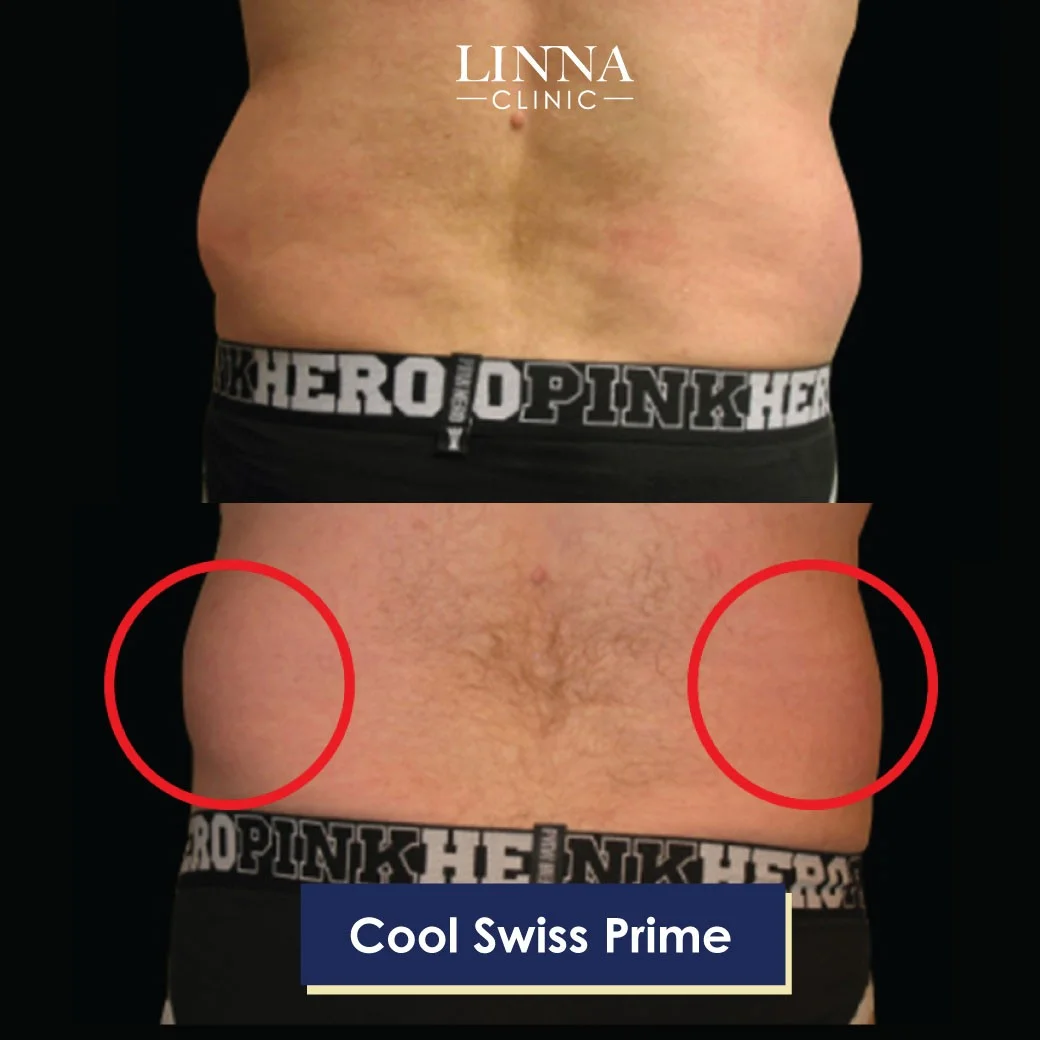 Cool Swiss Prime Plus results at LINNA Clinic