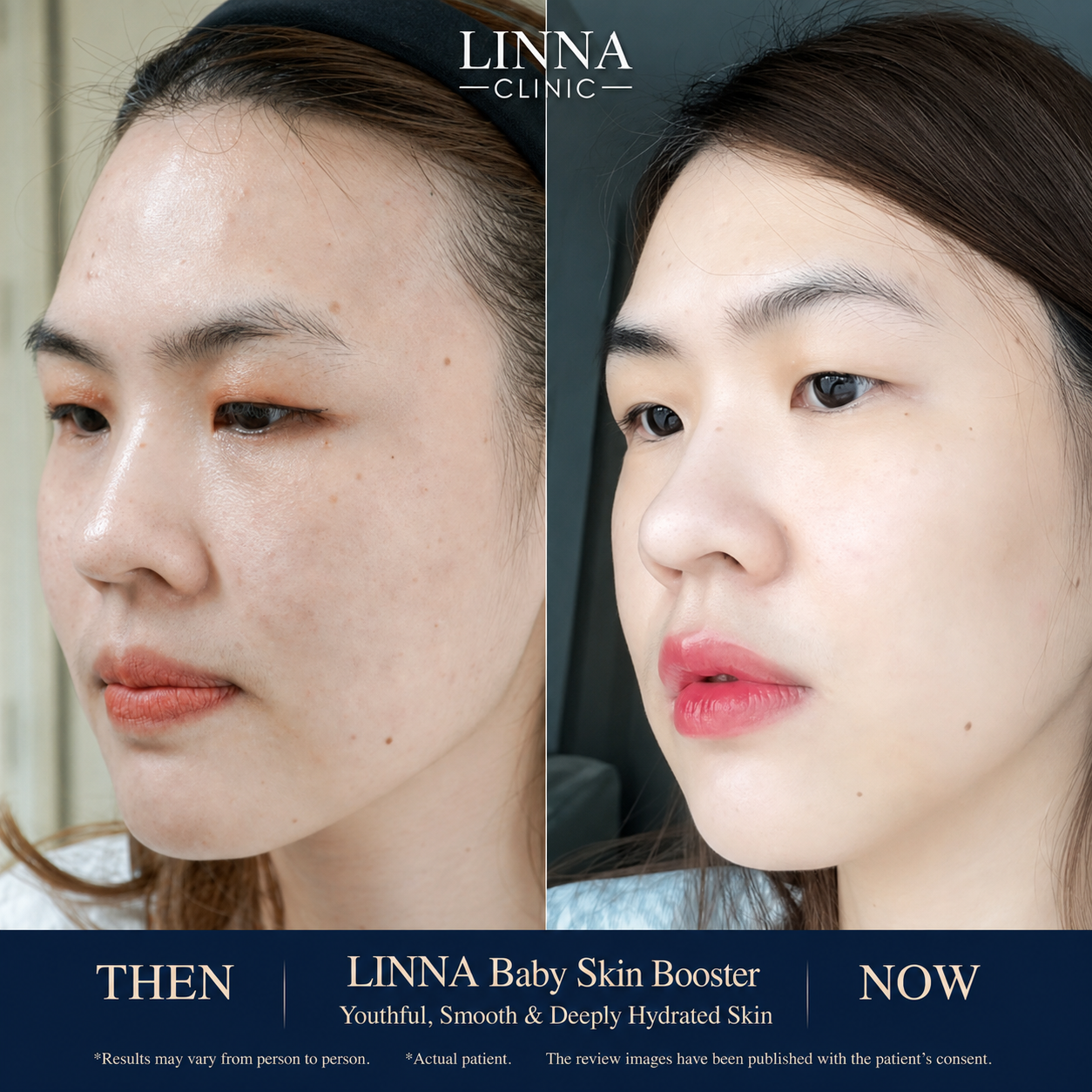 รีวิวก่อนและหลังทำ LINNA Baby Skin Booster