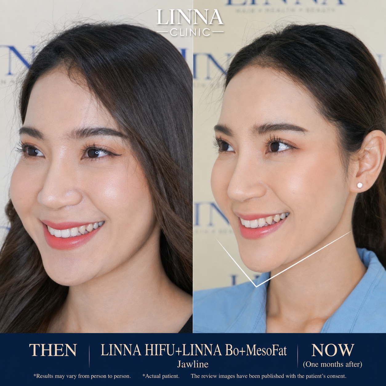 LINNA Clinic Bo ช่วยลดริ้วรอย ปรับรูปหน้าและรูปคิ้ว ไม่มีผลข้างเคียงและไม่ทิ้งสารตกค้างภายในร่างกาย