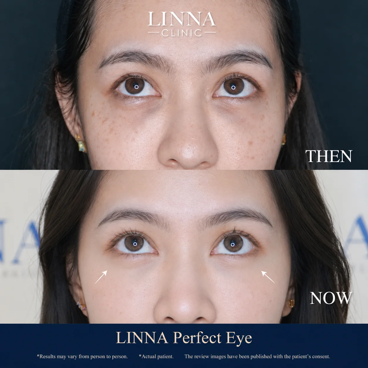 LINNA Perfect Eye before and after review 5