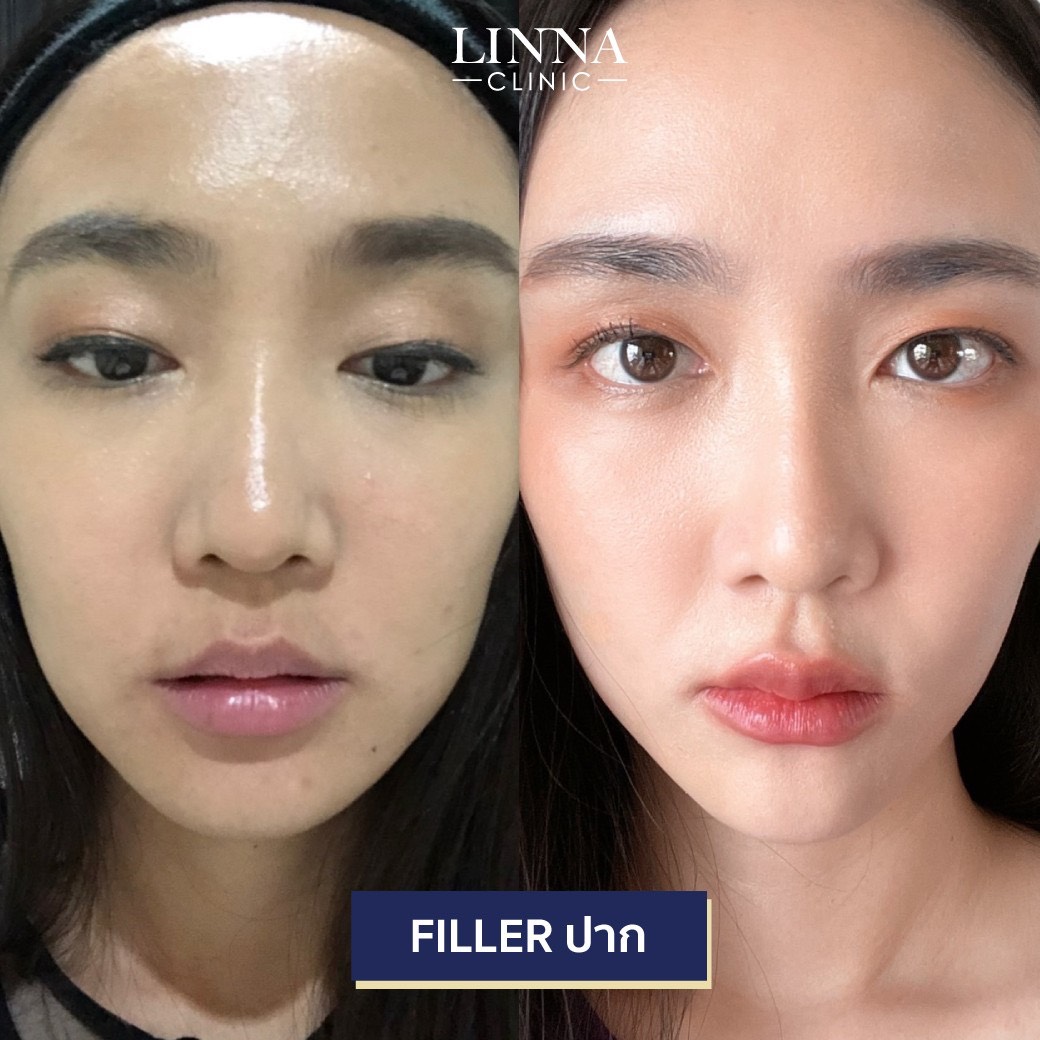 Lip filler before and after at LINNA Clinic