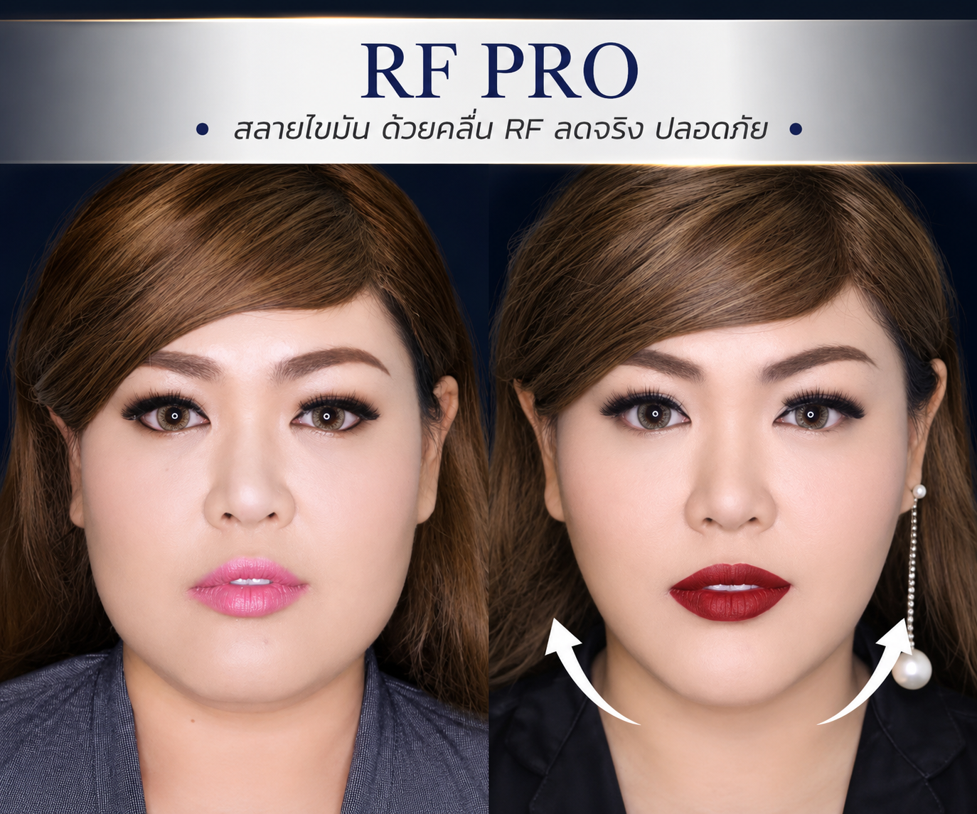 LINNA RF Pro at LINNA Clinic