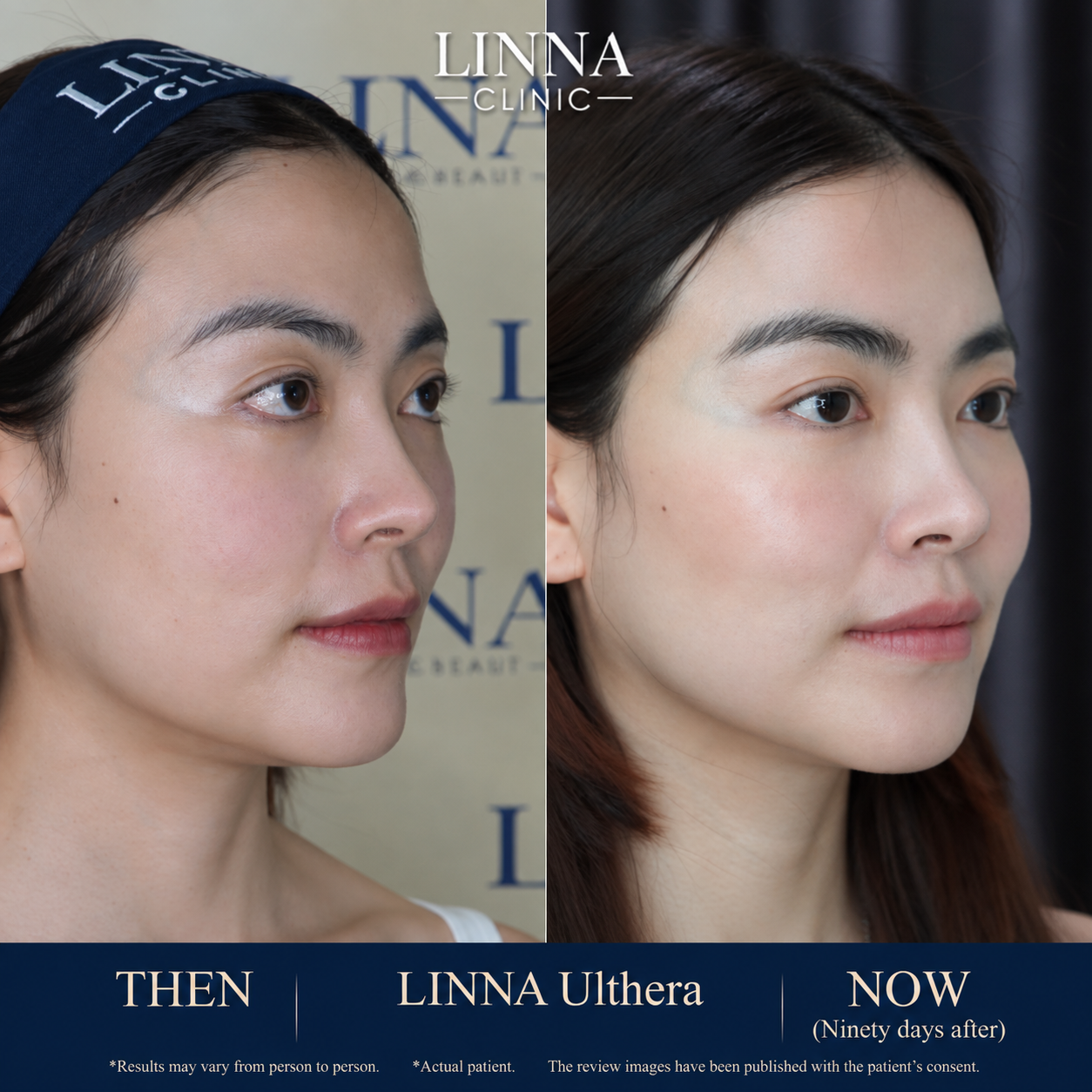LINNA Ulthera SPT before and after result