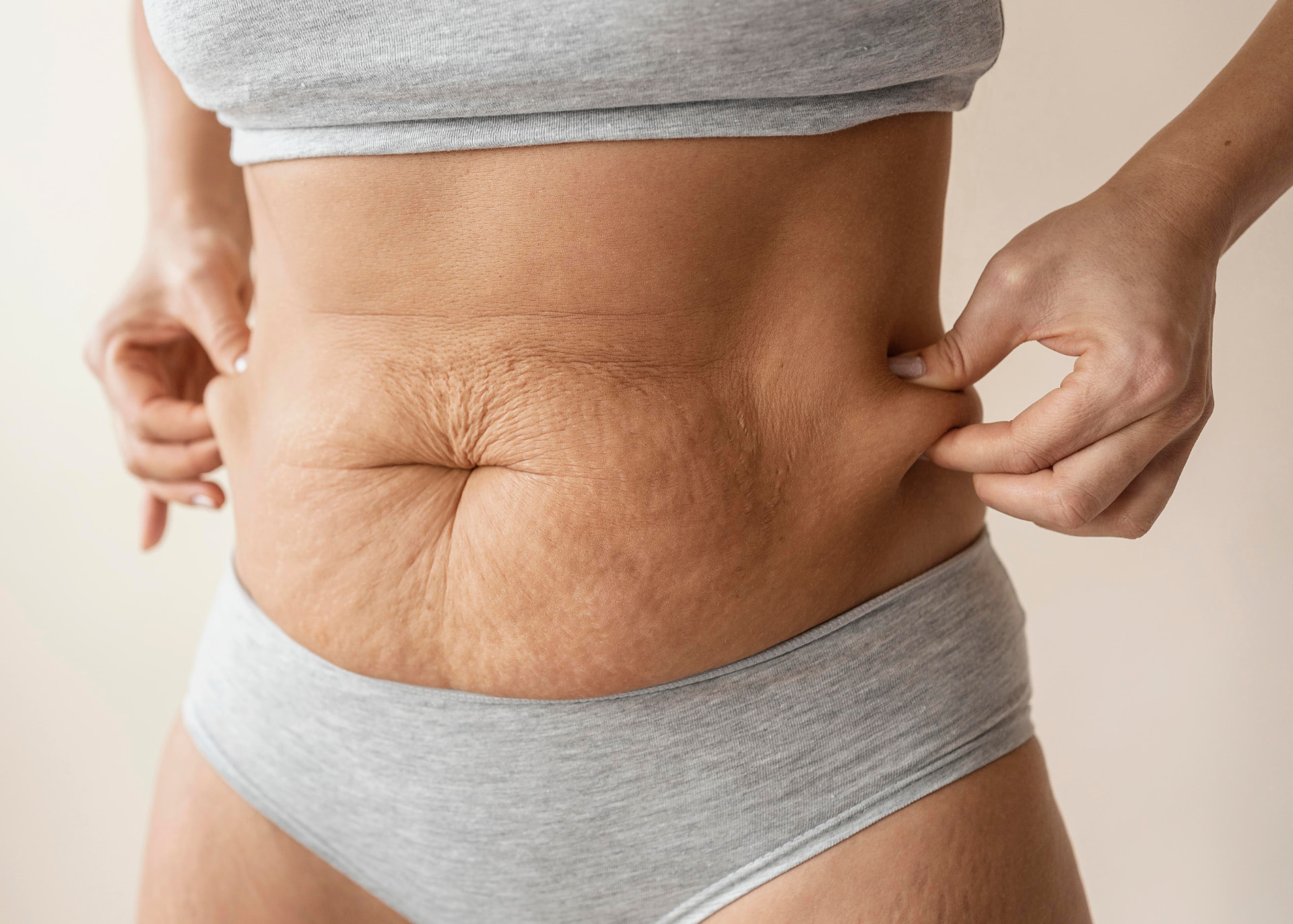 Loose and uneven abdominal skin after surgery and liposuction