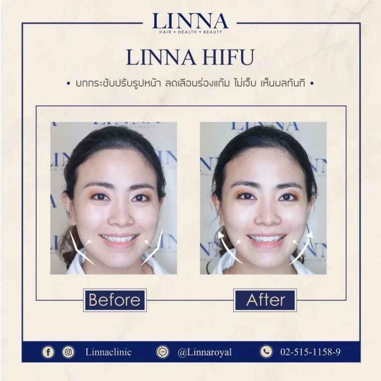 11 ข้อควรรู้ก่อนทำไฮฟู่ (Hifu) การรักษาความงามแบบไม่ต้องผ่าตัด