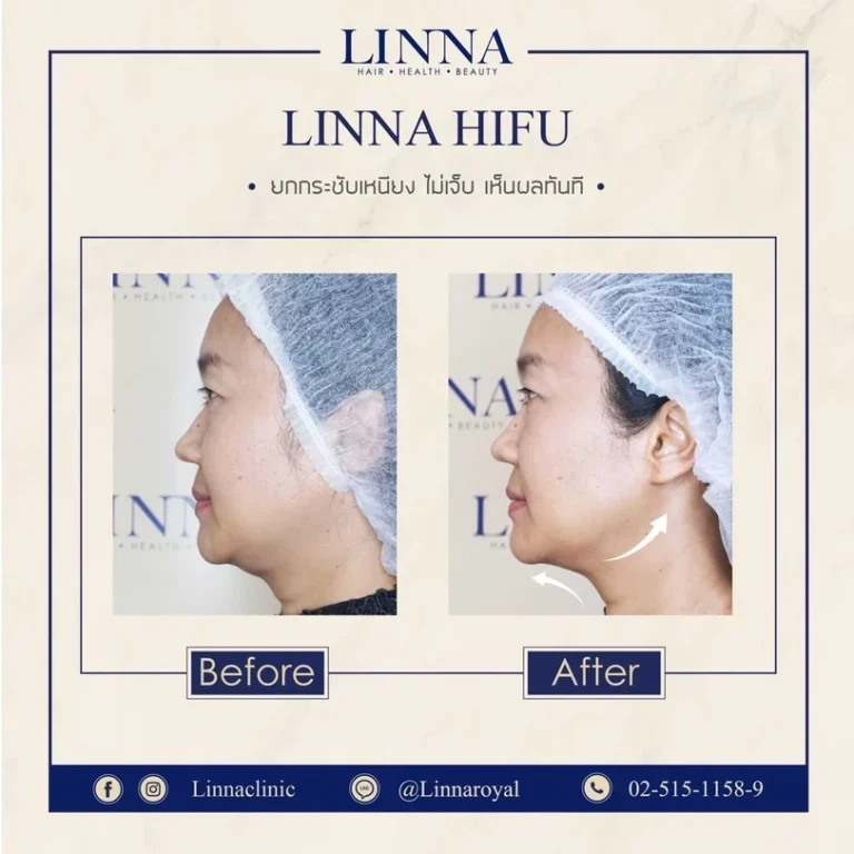 11 ข้อควรรู้ก่อนทำไฮฟู่ (Hifu) การรักษาความงามแบบไม่ต้องผ่าตัด