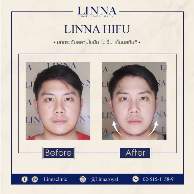 11 ข้อควรรู้ก่อนทำไฮฟู่ (Hifu) การรักษาความงามแบบไม่ต้องผ่าตัด