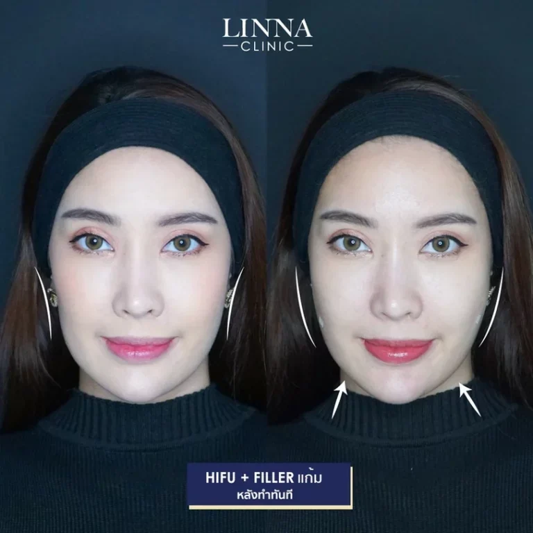 11 ข้อควรรู้ก่อนทำไฮฟู่ (Hifu) การรักษาความงามแบบไม่ต้องผ่าตัด