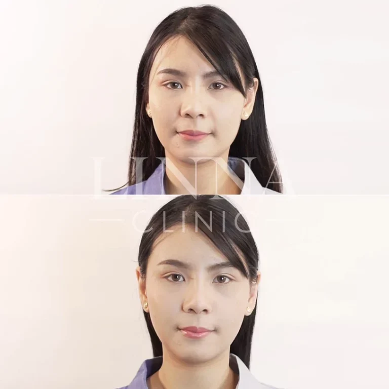 11 ข้อควรรู้ก่อนทำไฮฟู่ (Hifu) การรักษาความงามแบบไม่ต้องผ่าตัด