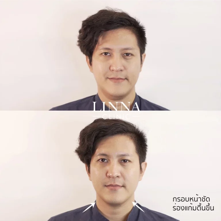 11 ข้อควรรู้ก่อนทำไฮฟู่ (Hifu) การรักษาความงามแบบไม่ต้องผ่าตัด
