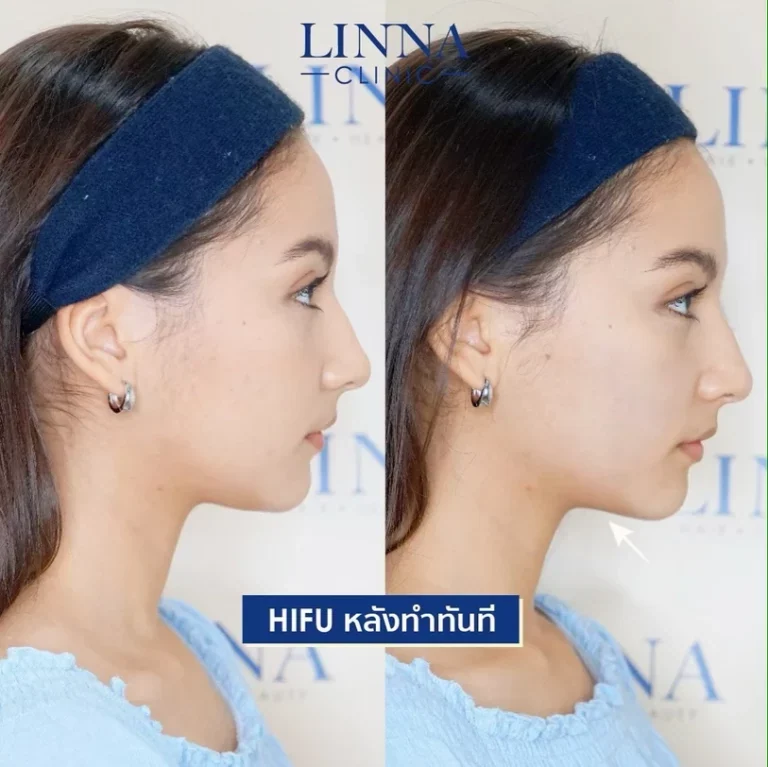 11 ข้อควรรู้ก่อนทำไฮฟู่ (Hifu) การรักษาความงามแบบไม่ต้องผ่าตัด