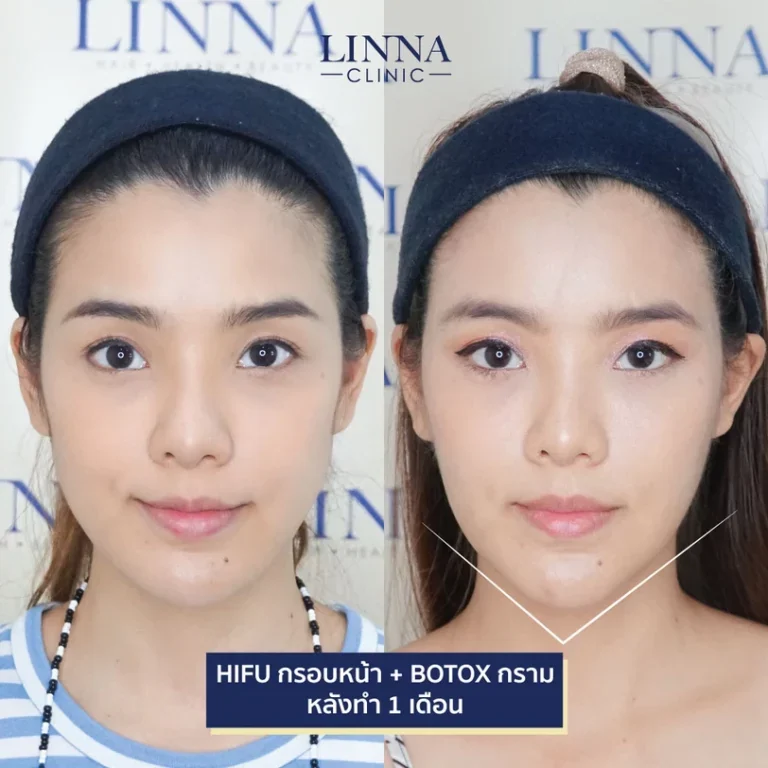 11 ข้อควรรู้ก่อนทำไฮฟู่ (Hifu) การรักษาความงามแบบไม่ต้องผ่าตัด