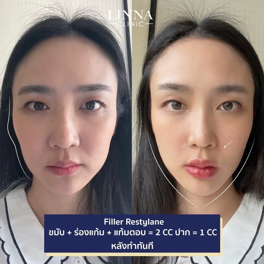 4 วิธีแก้แก้มตอบ ทวงคืนใบหน้าที่สดชื่นเปล่งปลั่ง !