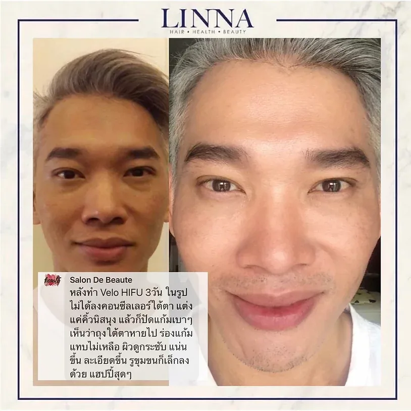 5 วิธีลดถุงใต้ตา บอกลาตาบวมตุ่ยฉบับง่ายและทำได้ทุกคน