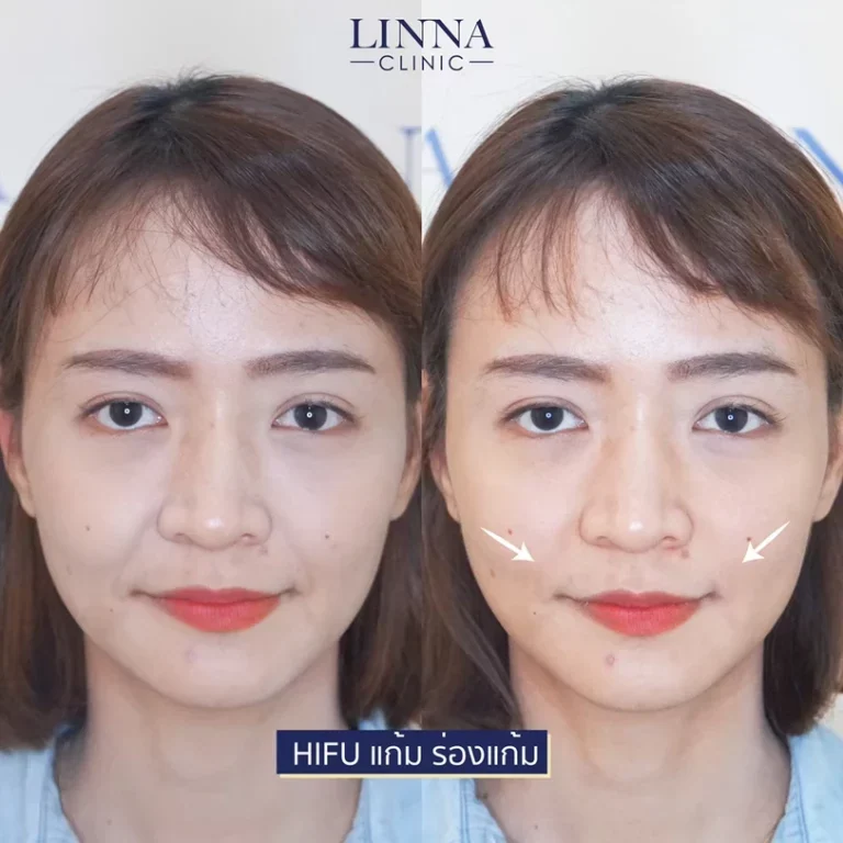 6 ความแตกต่างระหว่าง Ulthera และ Hifu แบบไหนดีกว่ากัน