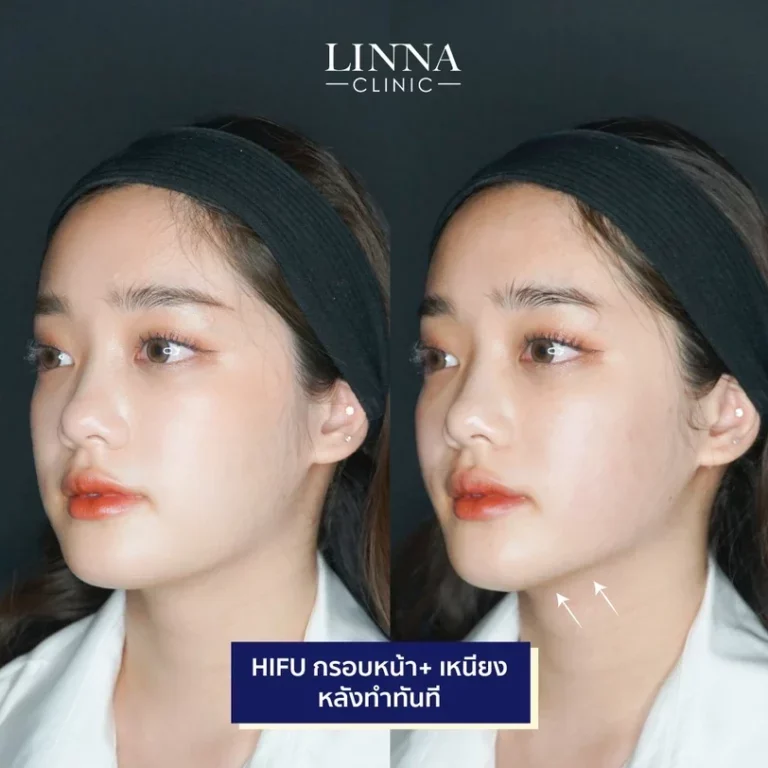 6 ความแตกต่างระหว่าง Ulthera และ Hifu แบบไหนดีกว่ากัน
