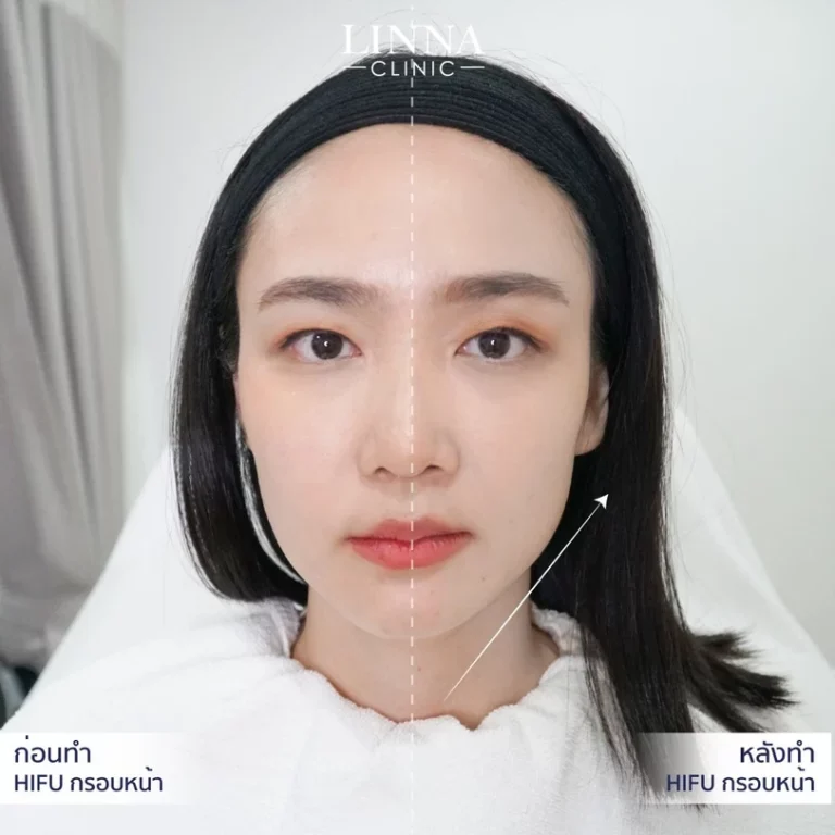6 ความแตกต่างระหว่าง Ulthera และ Hifu แบบไหนดีกว่ากัน