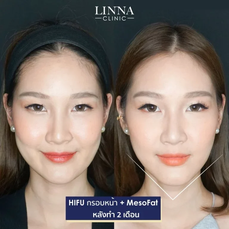 6 ความแตกต่างระหว่าง Ulthera และ Hifu แบบไหนดีกว่ากัน
