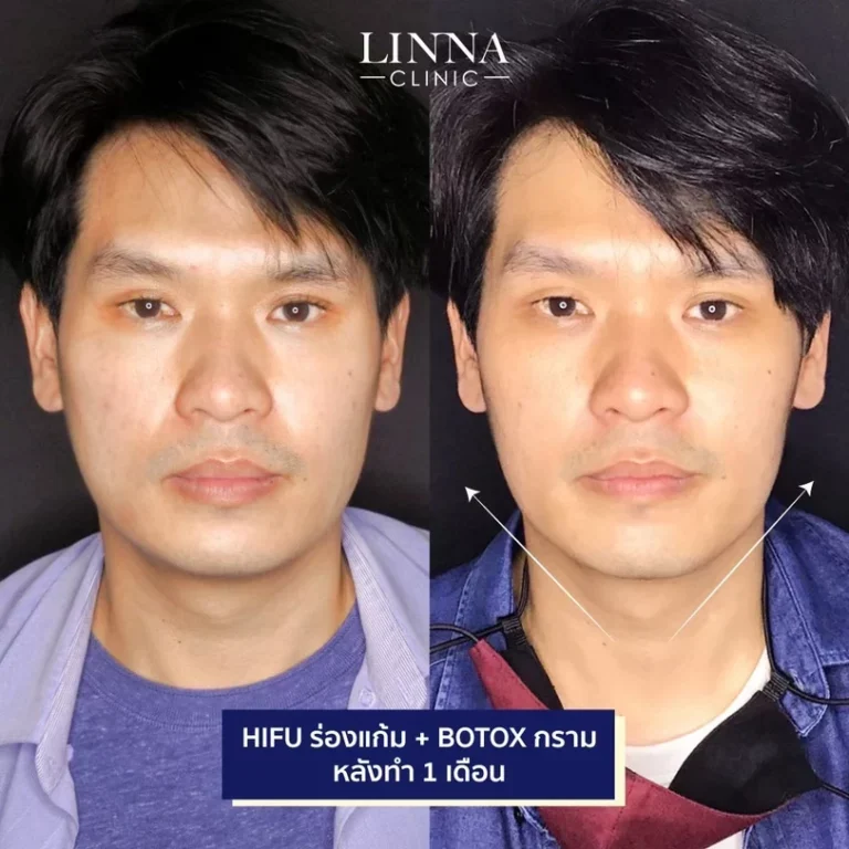 6 ความแตกต่างระหว่าง Ulthera และ Hifu แบบไหนดีกว่ากัน