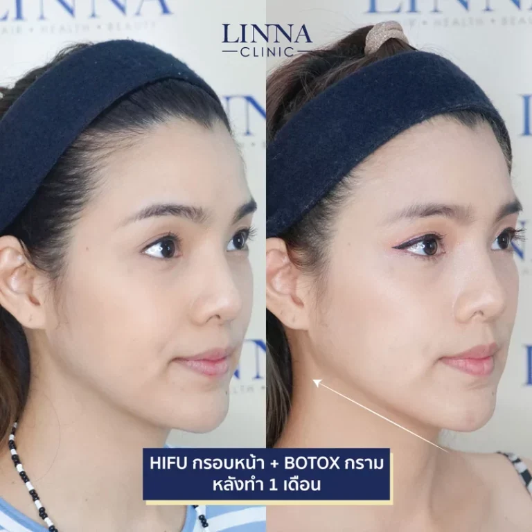 6 ความแตกต่างระหว่าง Ulthera และ Hifu แบบไหนดีกว่ากัน