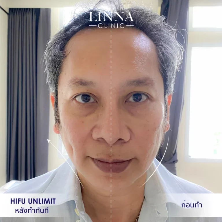 6 ความแตกต่างระหว่าง Ulthera และ Hifu แบบไหนดีกว่ากัน
