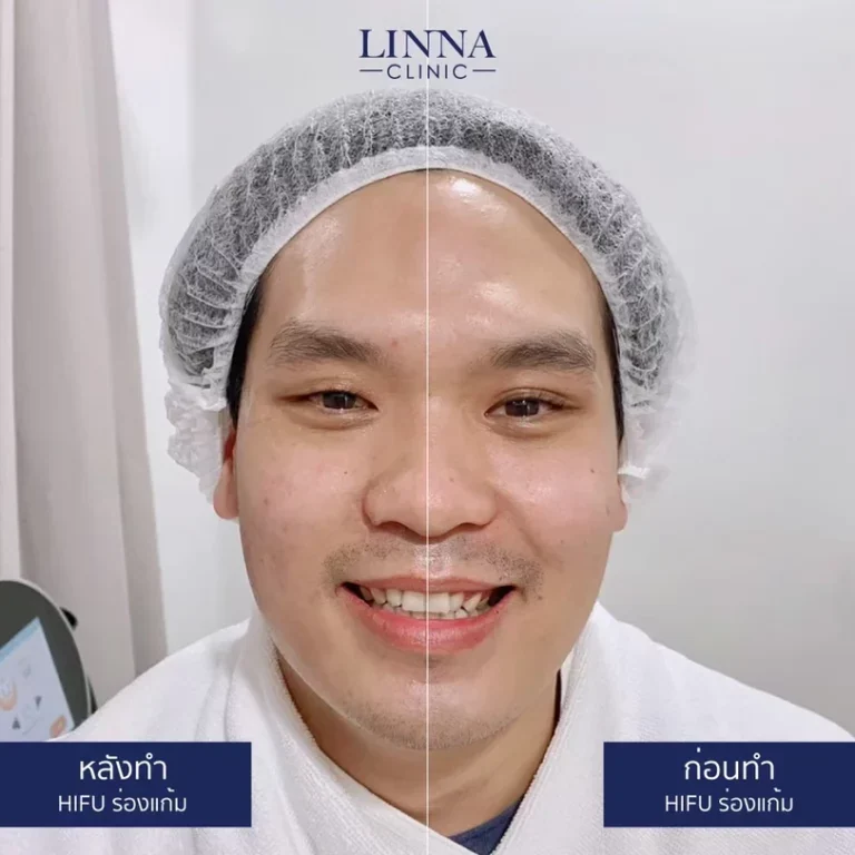 6 ความแตกต่างระหว่าง Ulthera และ Hifu แบบไหนดีกว่ากัน