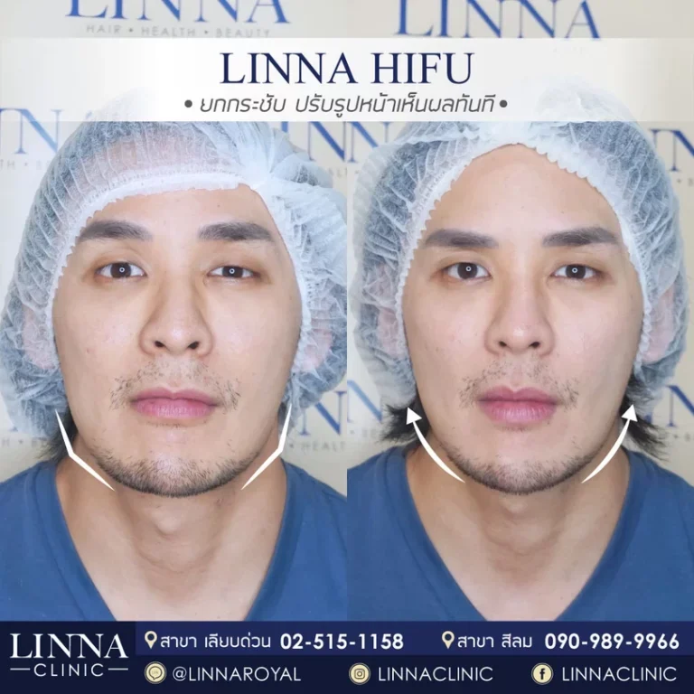 6 ความแตกต่างระหว่าง Ulthera และ Hifu แบบไหนดีกว่ากัน