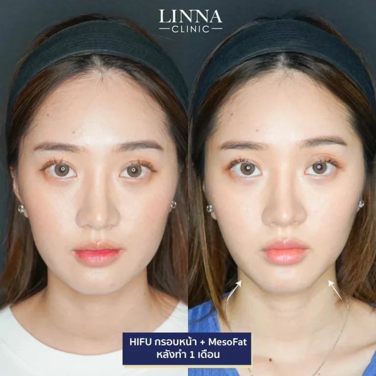 6 ความแตกต่างระหว่าง Ulthera และ Hifu แบบไหนดีกว่ากัน