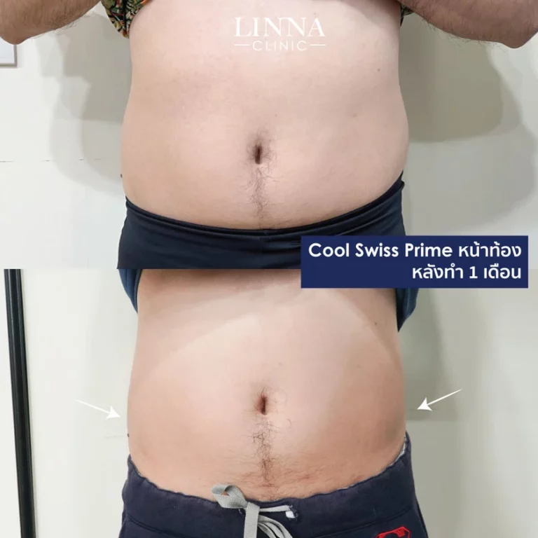 6 วิธีลดพุง สำหรับคนไม่มีเวลาออกกำลังกาย แบบเร่งด่วน เห็นผลเร็ว
