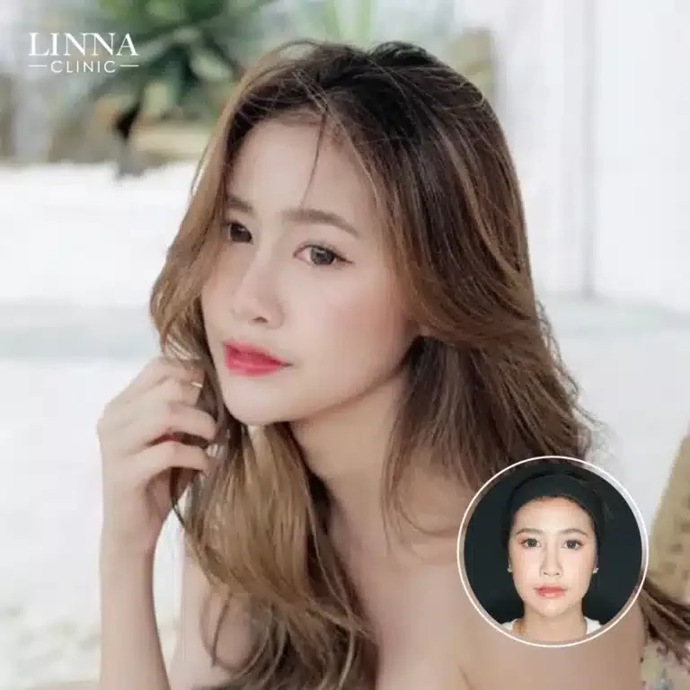 8 ความแตกต่าง LINNA HIFU vs Ultraformer ต่างกันอย่างไร