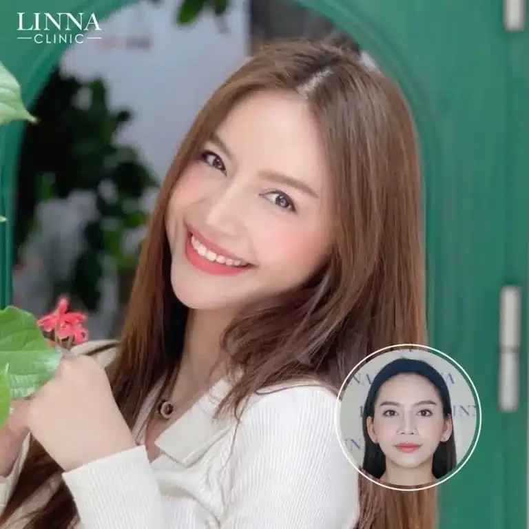 8 ความแตกต่าง LINNA HIFU vs Ultraformer ต่างกันอย่างไร