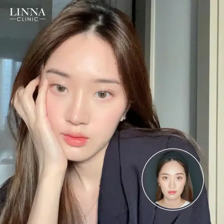 8 ความแตกต่าง LINNA HIFU vs Ultraformer ต่างกันอย่างไร